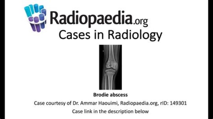 Brodie Moss Finger Bite: Decoding the Buzz Around a Curious Search