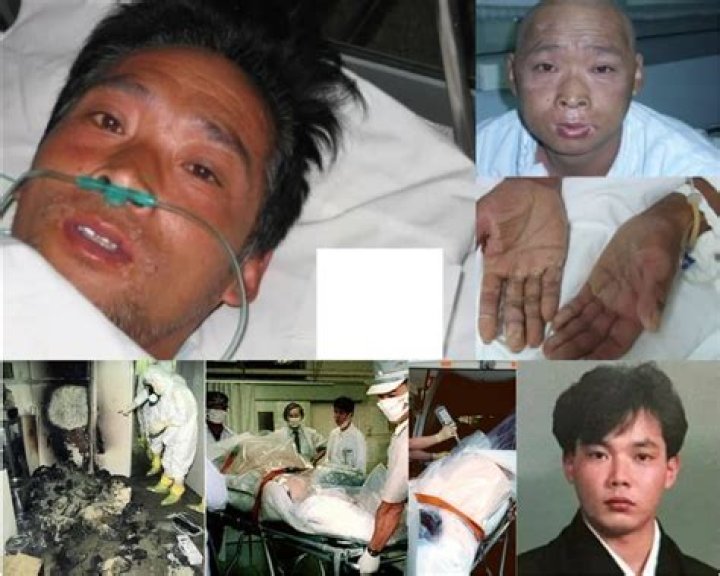 Understanding Hisashi Ouchi's Injuries: A Look at the Tokaimura Accident's Human Cost